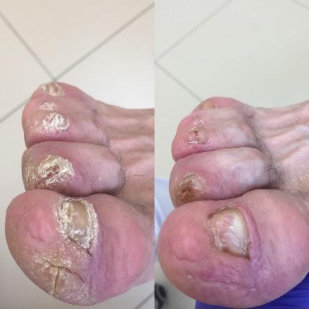 Результат лікування проблем з нігтями
