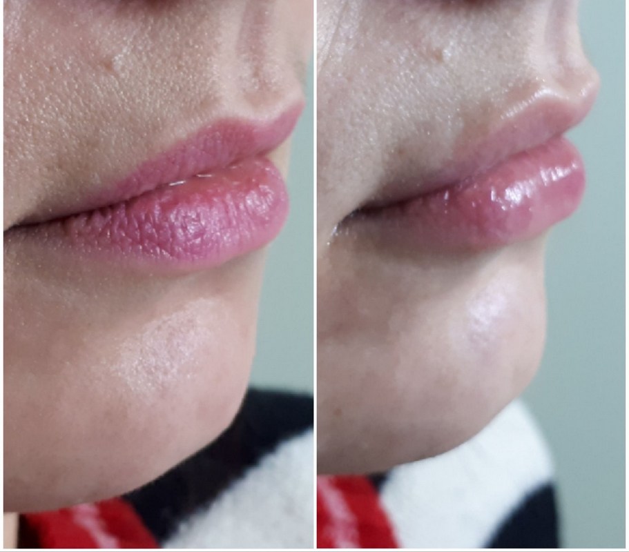 фото до і після конторної пластикі губ